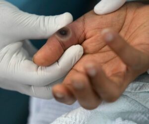 Jamaica confirms two more monkeypox cases Loop Jamaica